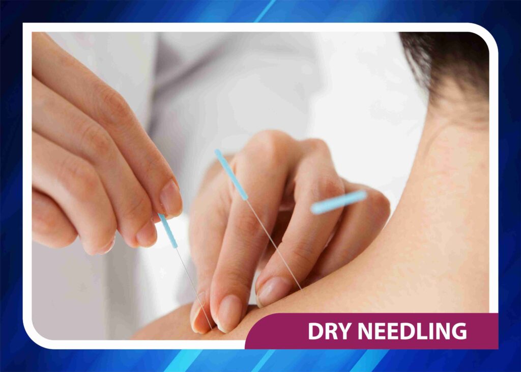 Dry needling for trigger point therapy