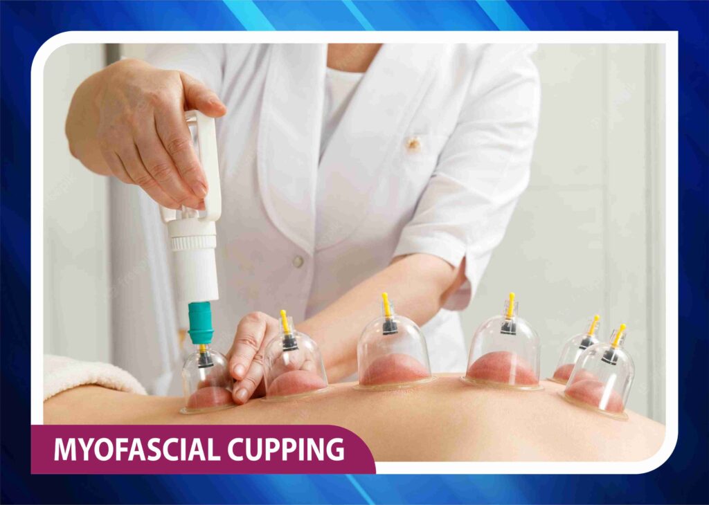Myofascial cupping therapy session