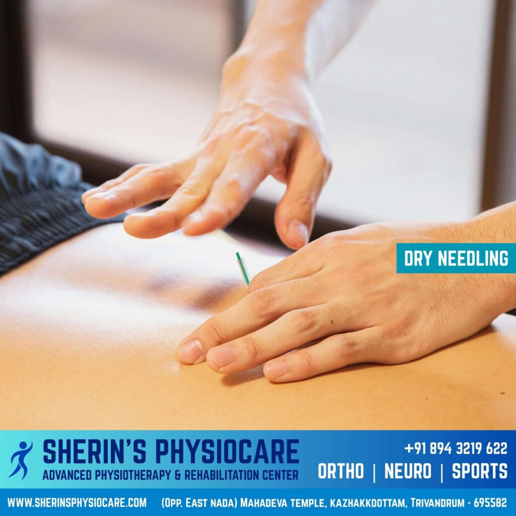Dry needling physiotherapy treatment in Trivandrum